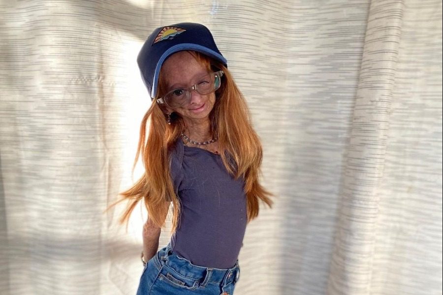 Η ιστορία της Adalia Rose Williams που μας συγκλόνισε από την πρώτη στιγμή - Πέθανε η σταρ του YouTube που έπασχε από τη νόσο Benjamin Button
