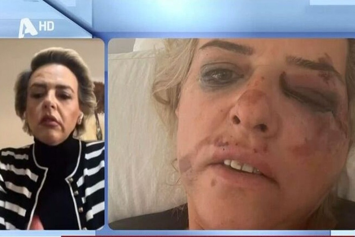 «Θα μπορούσα να είμαι στη θέση της 50χρονης» - Συγκλονίζει γυναίκα για την επίθεση από σκυλιά