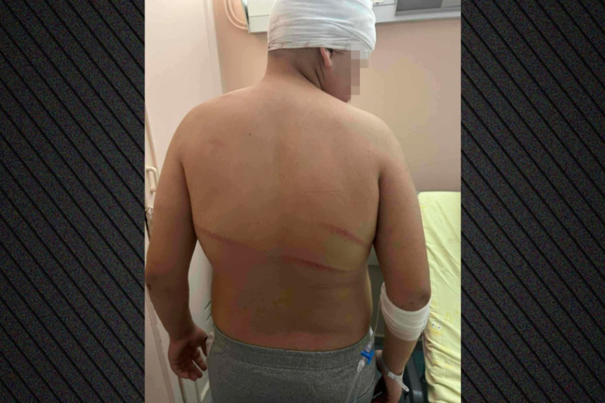 Θεσσαλονίκη: «Τον χτυπούσαν με μπετόβεργες, έχει τρύπες 15 πόντους στο κεφάλι»